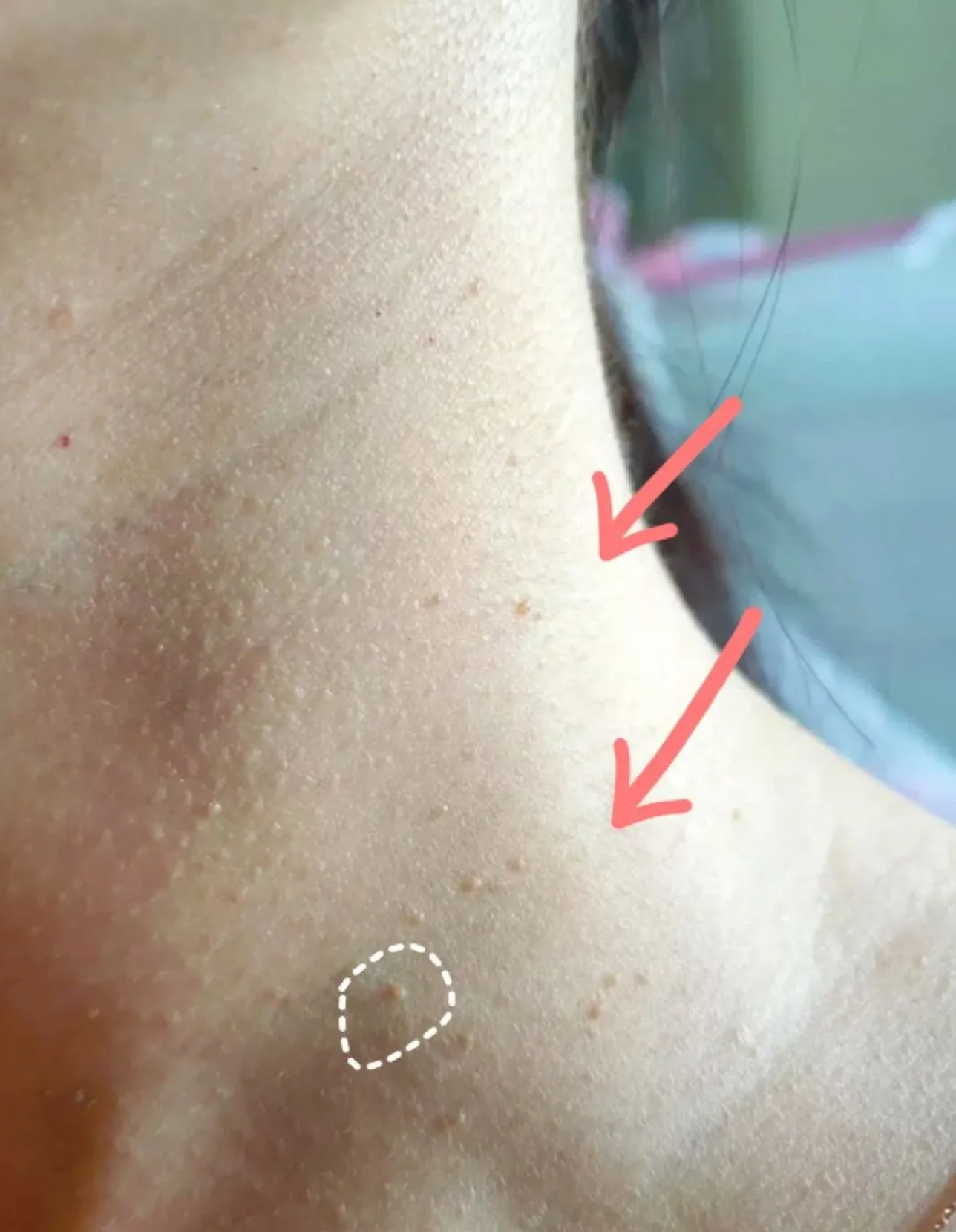 症状因人而异,是否瘙痒不能直接判断是否hpv