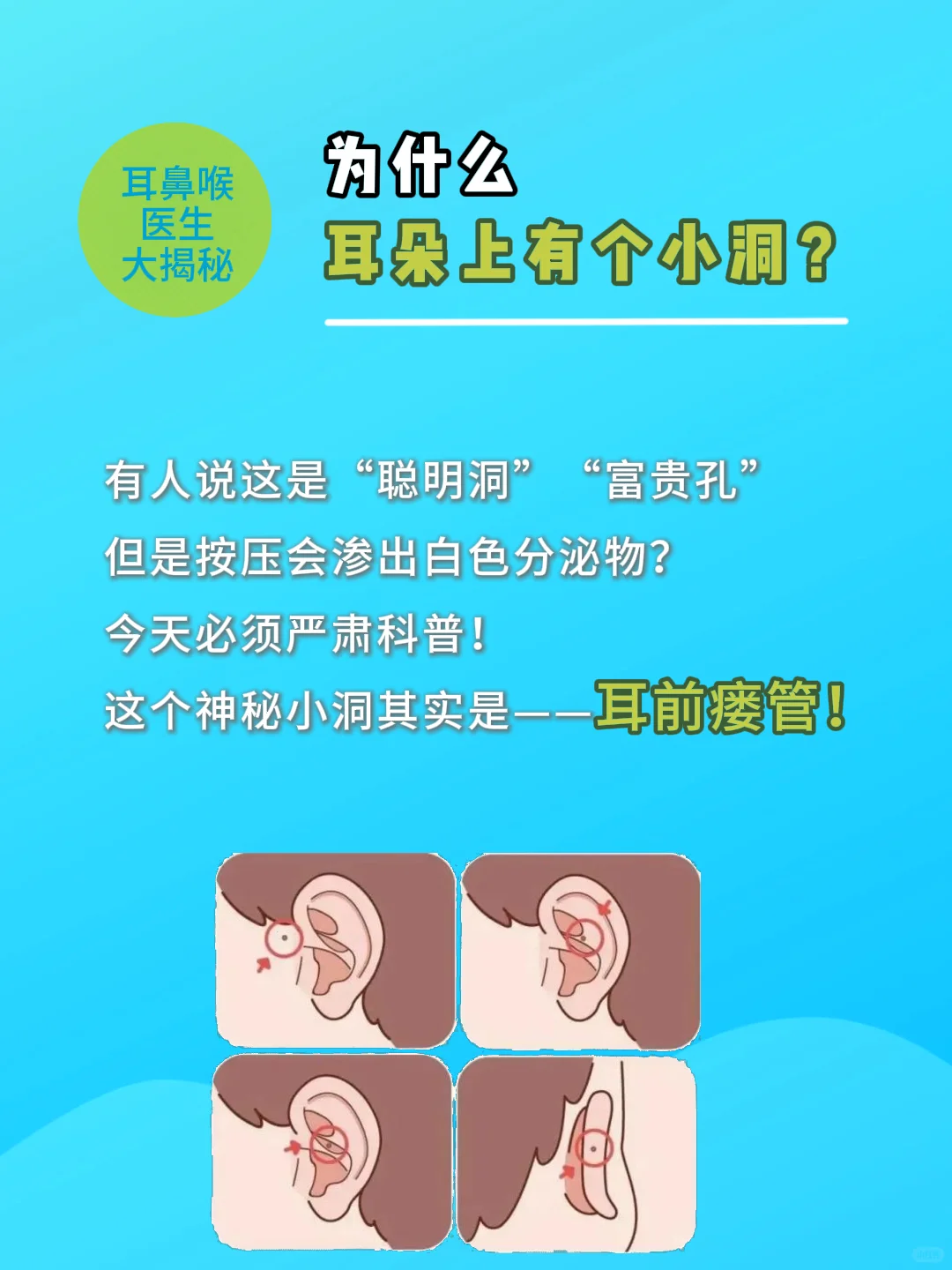 耳朵上有个小洞,医学叫耳前瘘管,是先天发育不良造成的