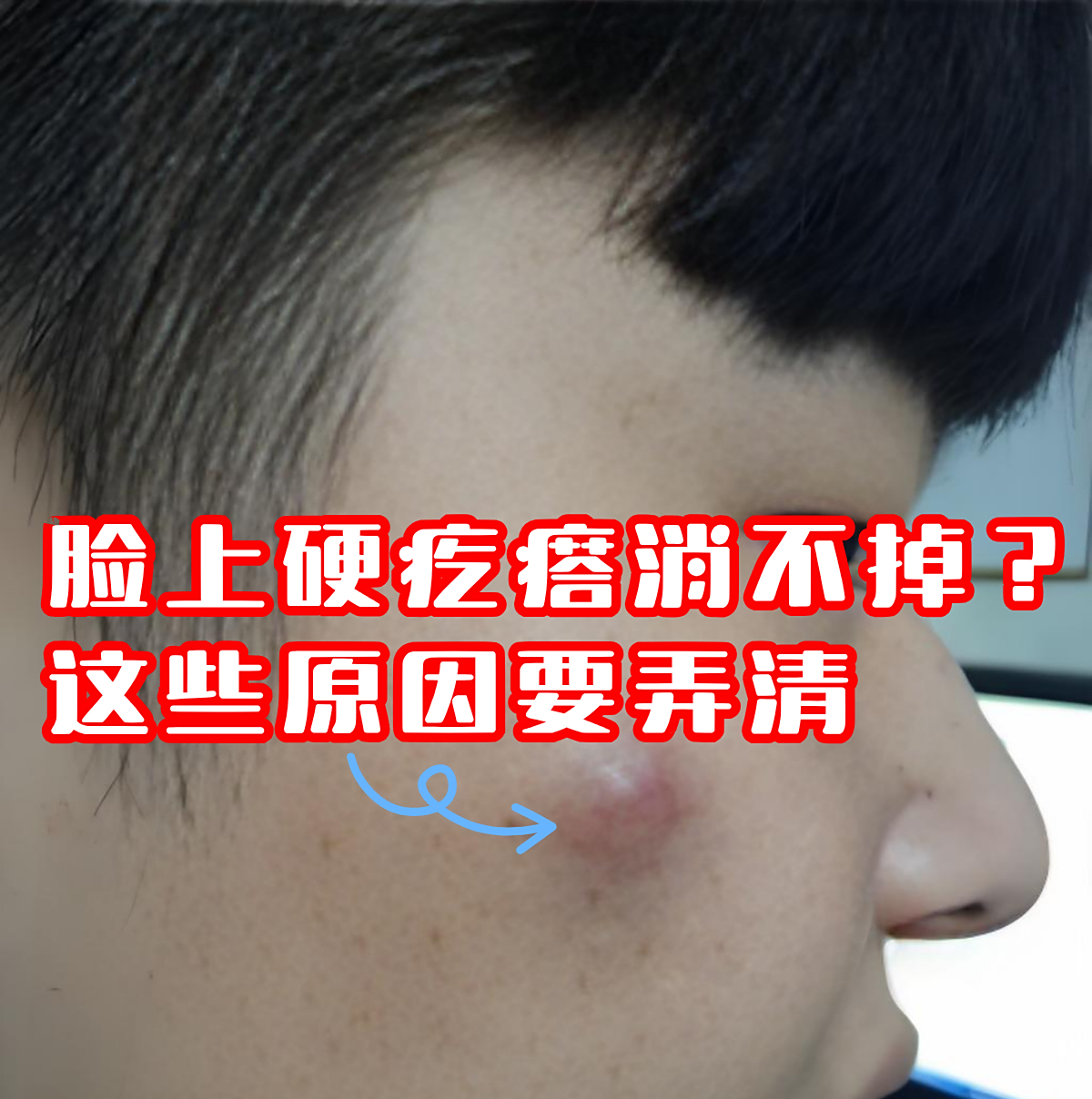 1闭口粉刺:皮脂腺分泌旺盛 毛囊口角化异常