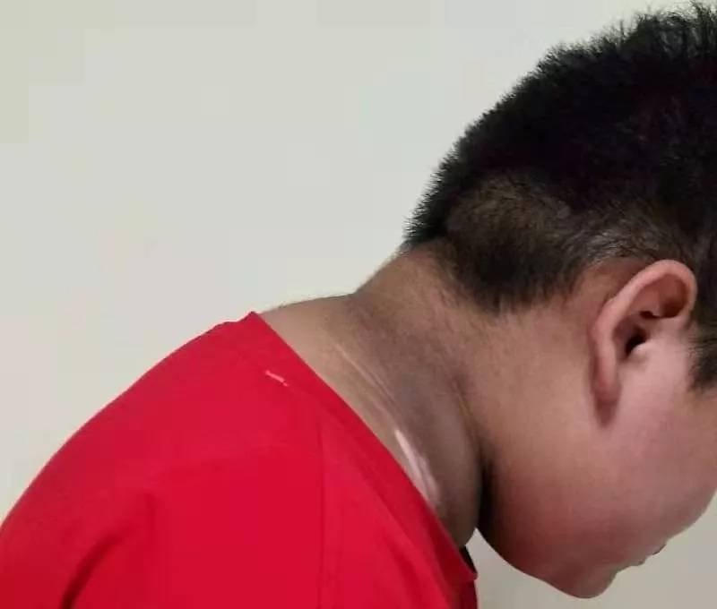 脖子黑有可能是假性黑棘皮病,常和肥胖有关;也可能是局部摩擦,晒太阳