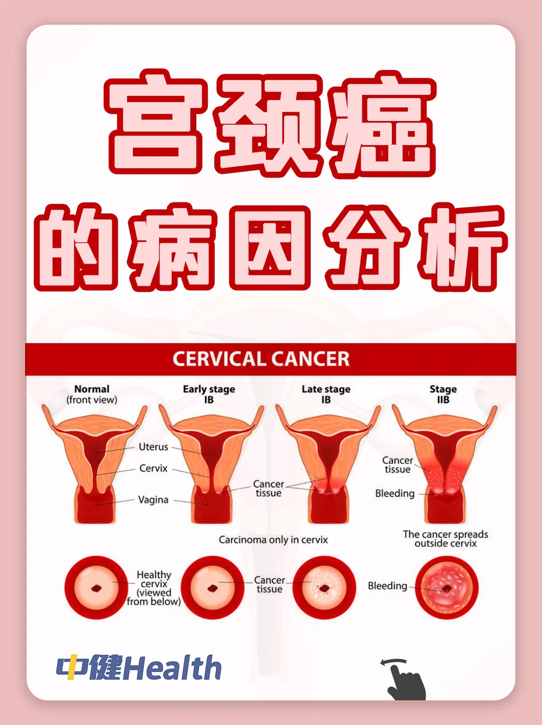 宫颈癌主要是由人乳头瘤病毒
