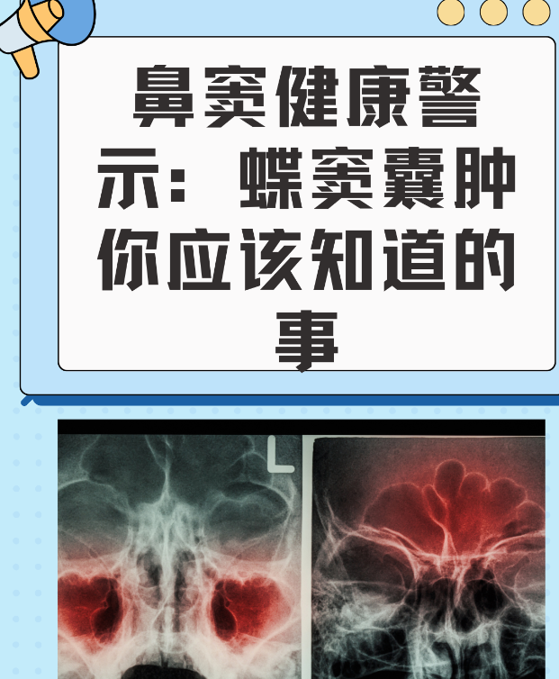 蝶窦囊肿是长在蝶窦部位的囊肿,蝶窦在脑袋深处