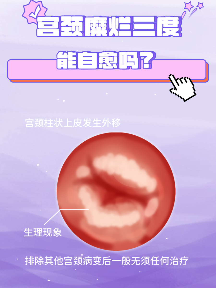 宫颈糜烂三度一般不能自愈