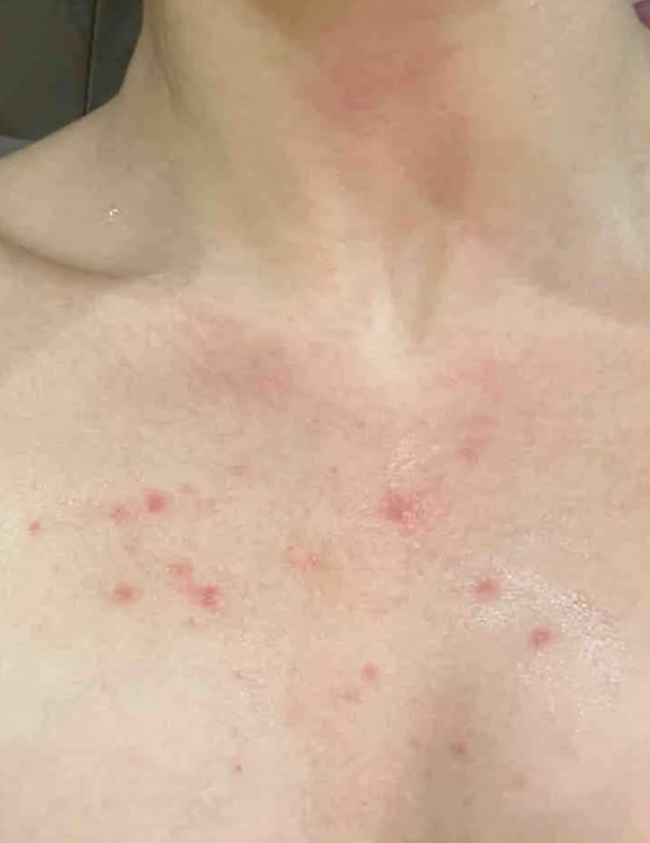 hiv感染者有可能在胸前长红点