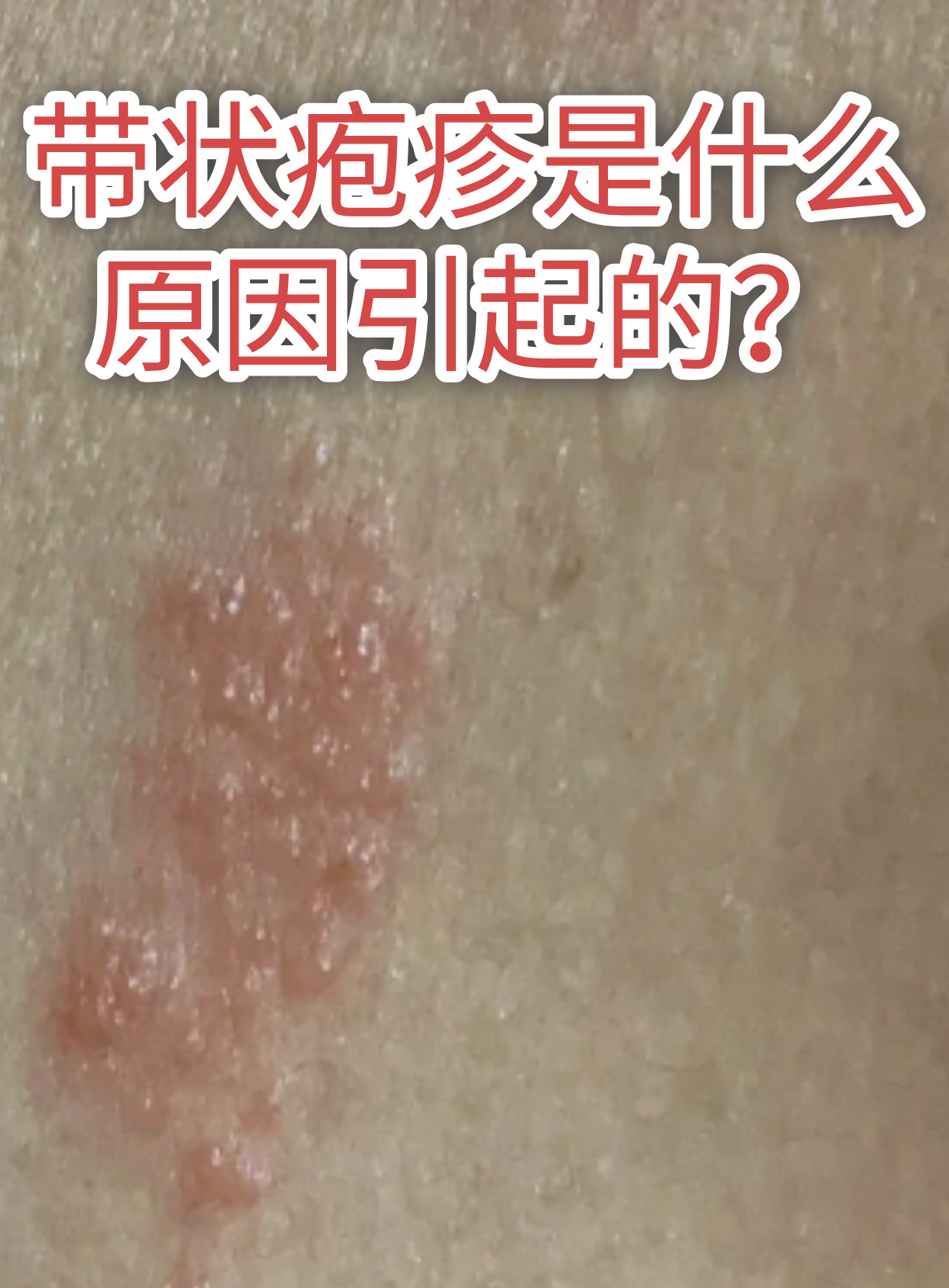 带状疱疹主要是由水痘
