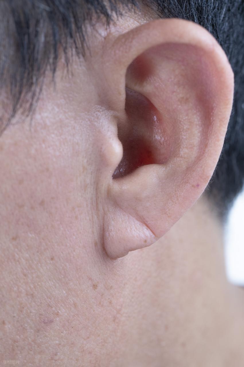 耳朵上有这条折痕,是心梗,猝死的"标志"?医生:警惕6个异常