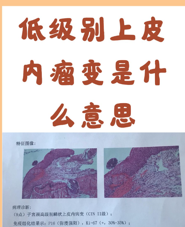 它表示上皮细胞有了不典型增生,但程度比较轻