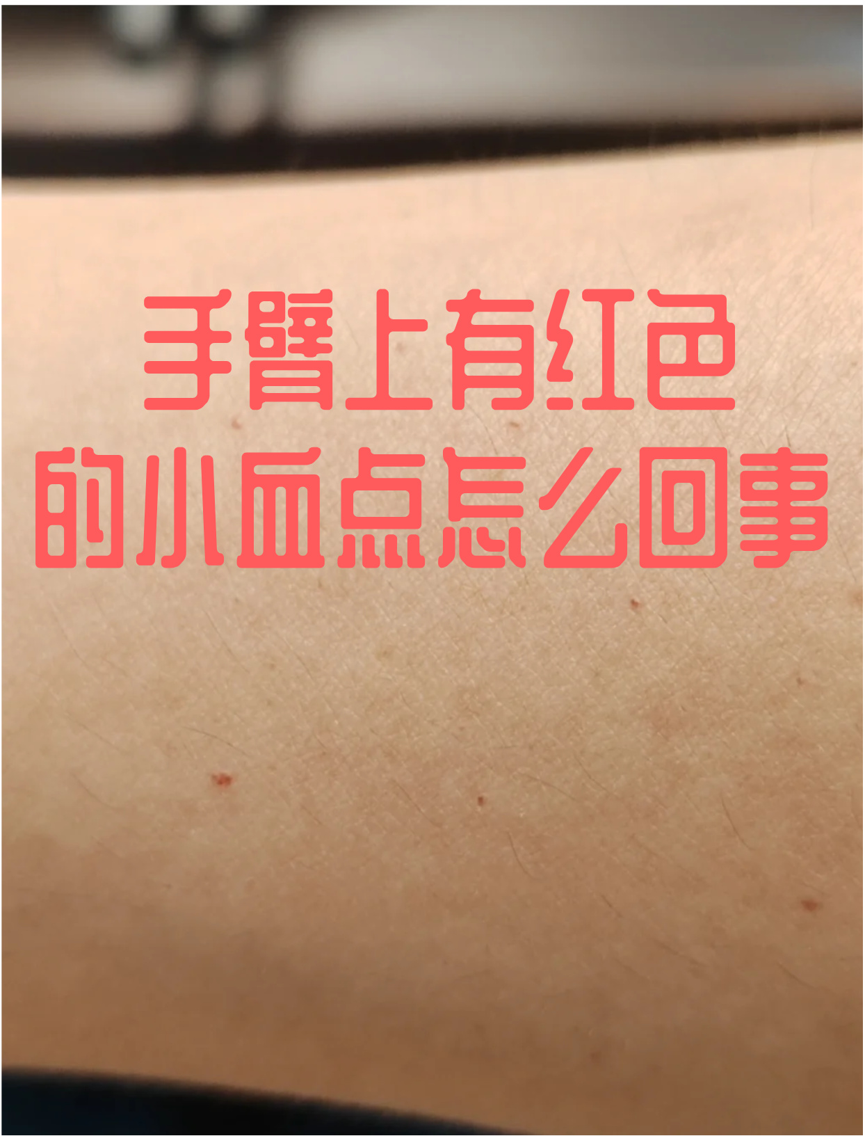 一般来说,可能是毛细血管破裂出血,形成了这种小血点