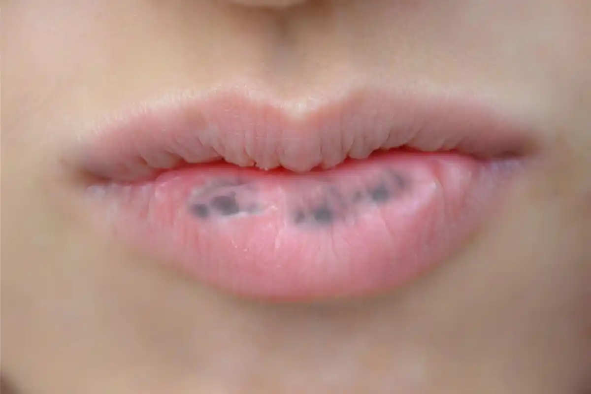 嘴唇长黑斑会变成癌吗?