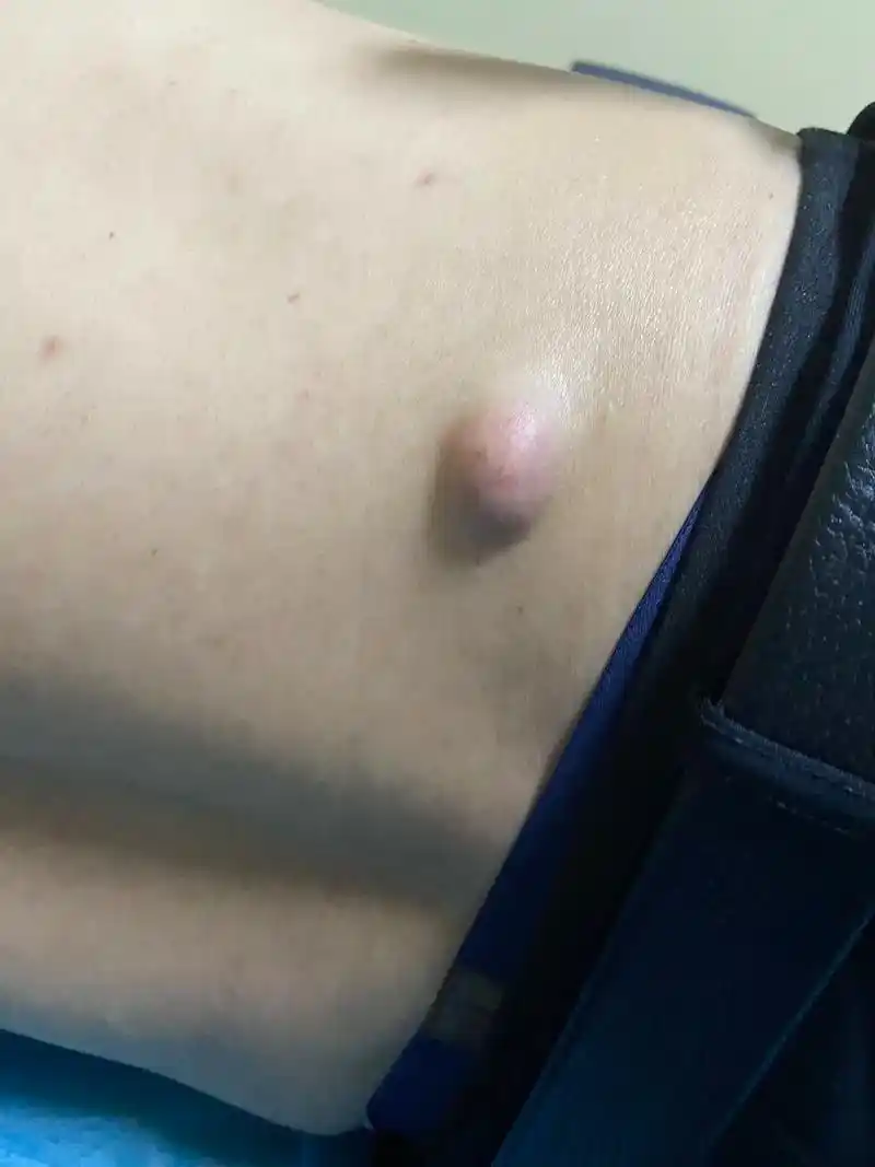 皮脂腺囊肿的4个复发信号!