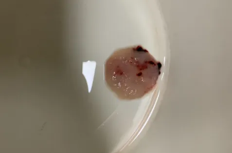 自然流产孕囊什么样?排出物自查图解