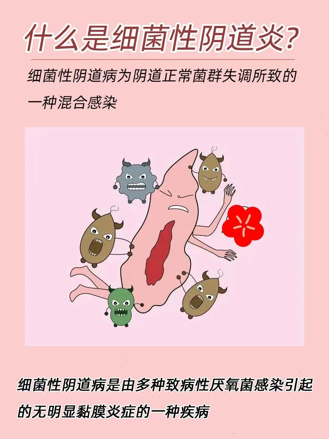 细菌性阴道炎是一种常见炎症,由细菌失衡引起