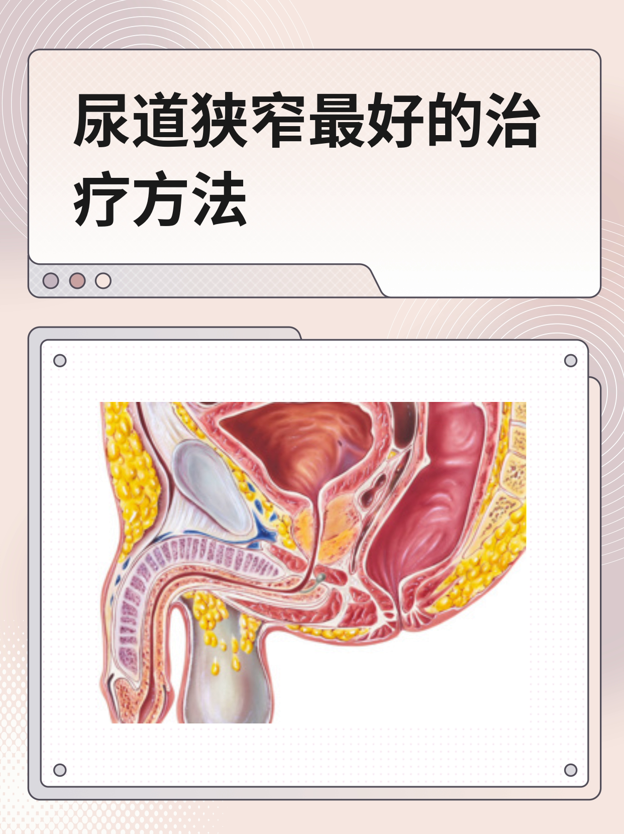 治疗男性尿道狭窄没有绝对最好的方法,得看具体病情