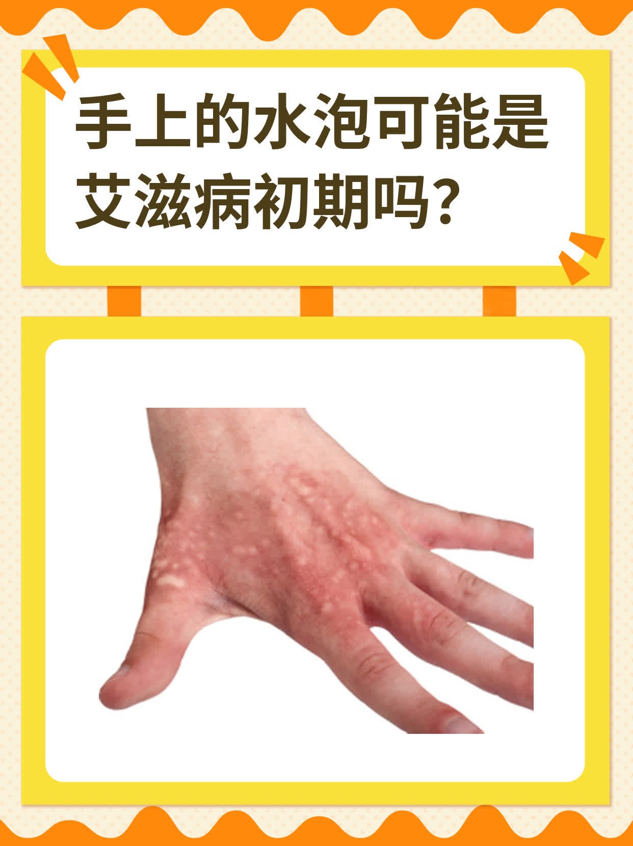 艾滋病初期有可能出现水泡症状