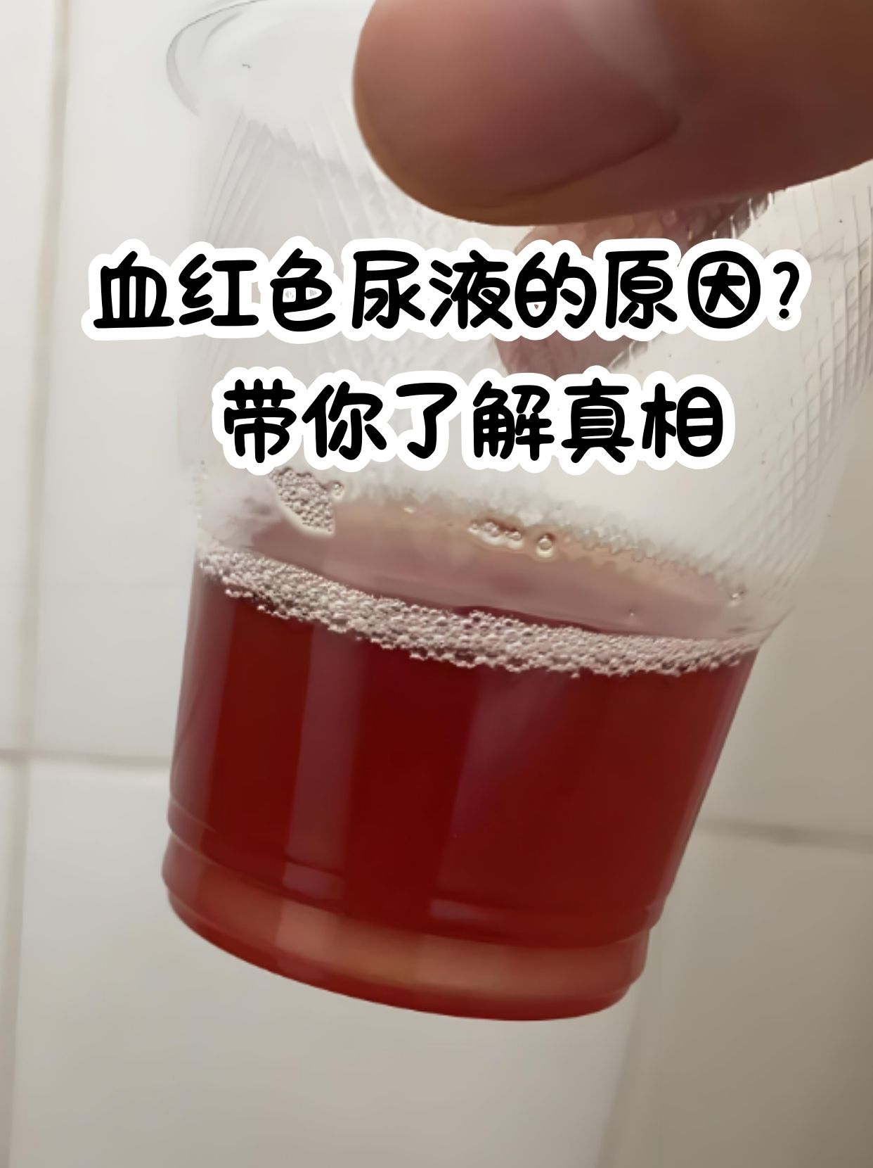 尿液呈红色可能是吃了特殊食物或药物,也可能是身体出问题