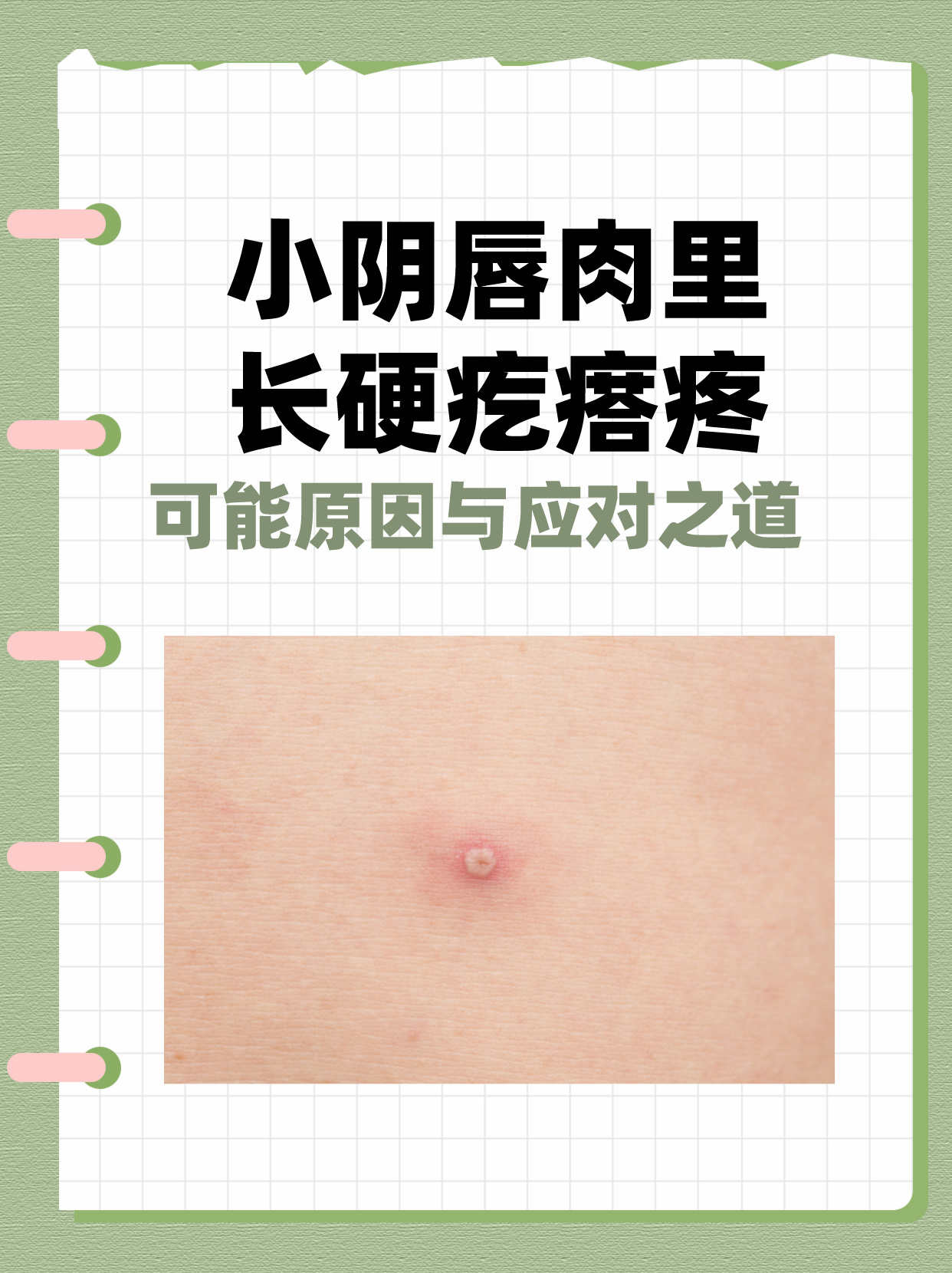 私处唇瓣长小疙瘩,可能是清洁不到位,也可能是炎症刺激,还可能