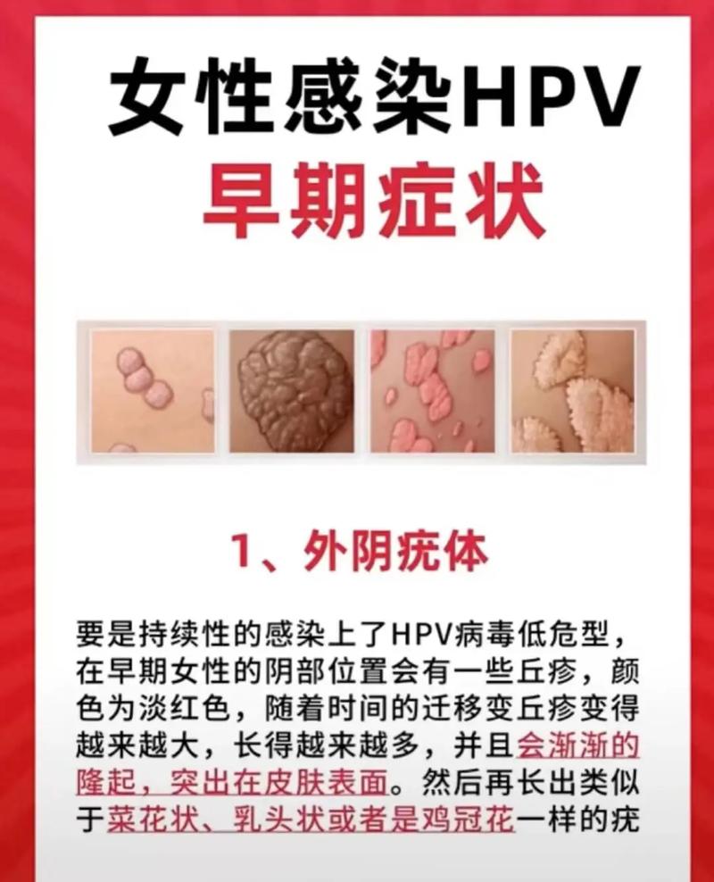 女性感染hpv可能有哪些症状?