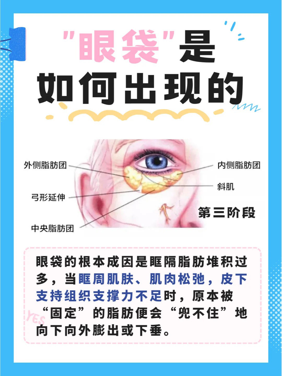 眼袋形成原因有多种