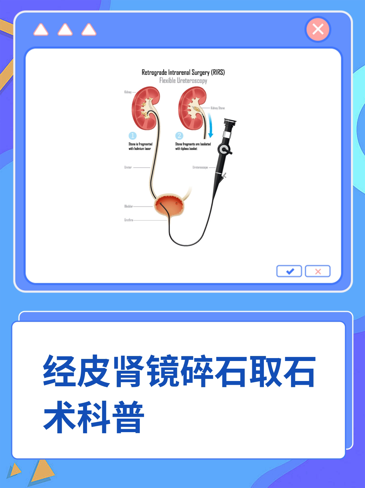 经皮肾镜碎石取石术是治疗肾结石等的方法