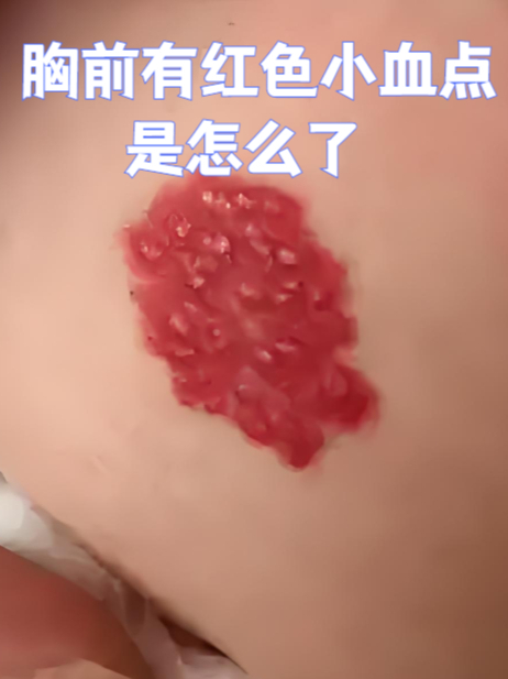 胸前有红色小血点是怎么了