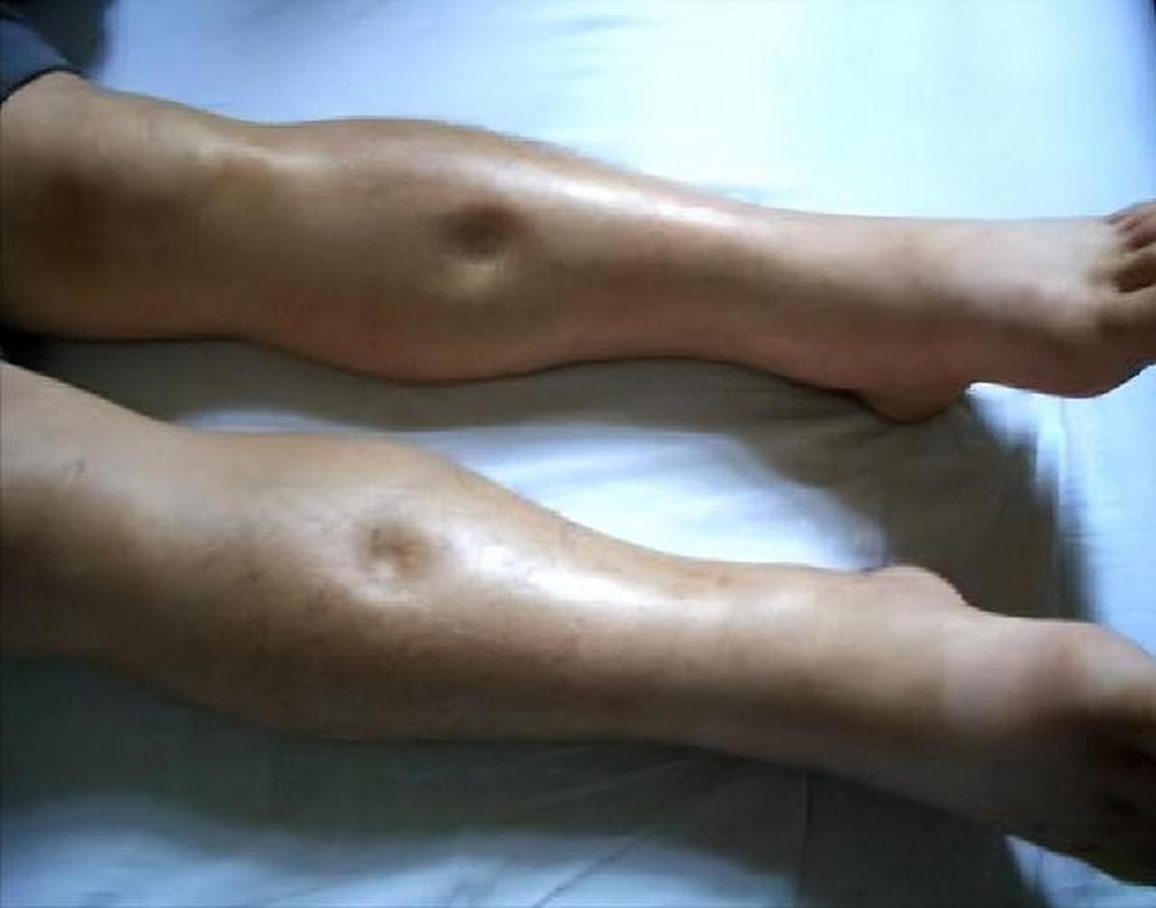 冠心病人一旦活过75岁,一般就出现了如下症状,建议了解