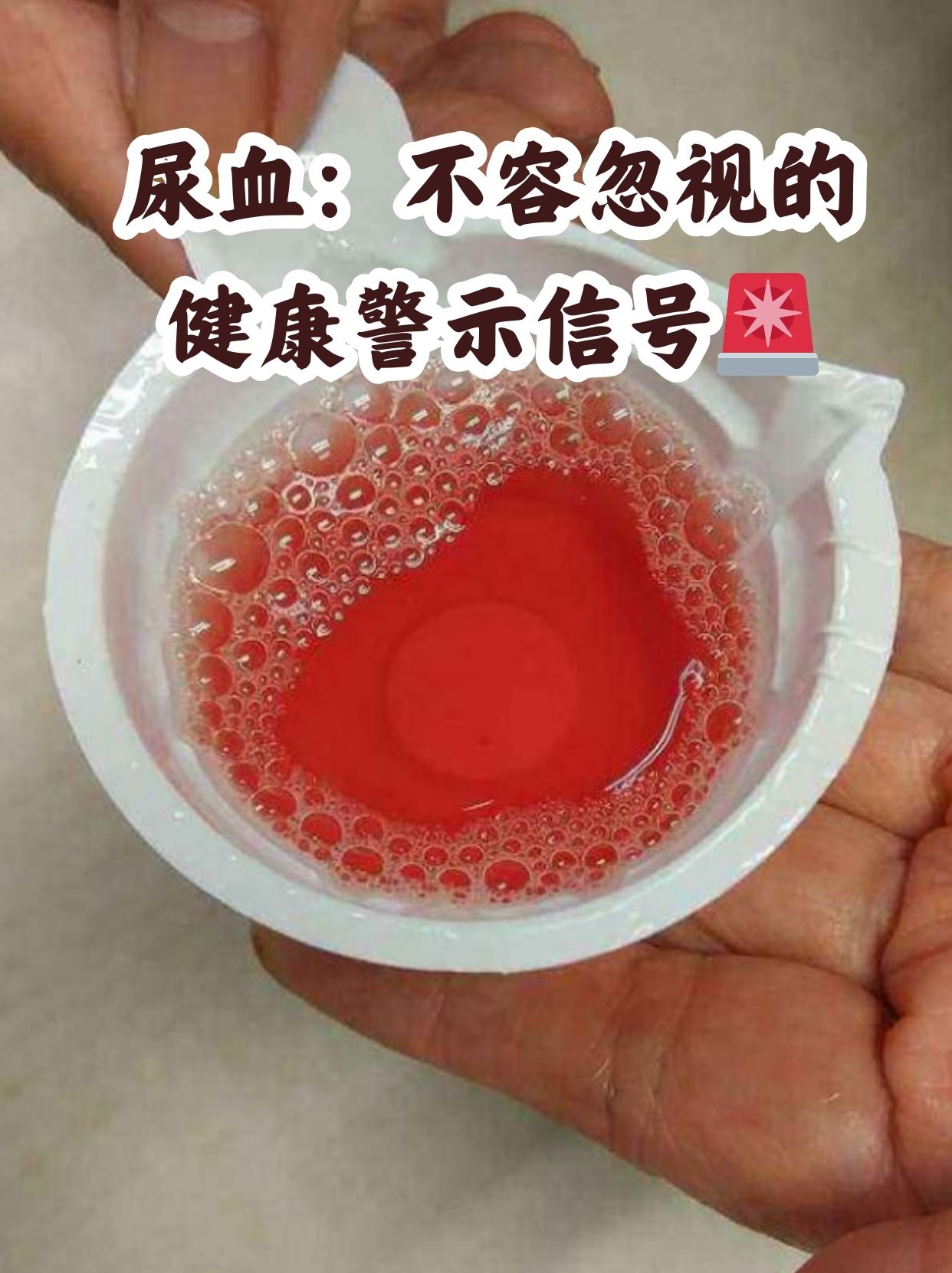 尿液呈粉红色,可能是吃了特殊食物或药物,也可能是身体出问题了