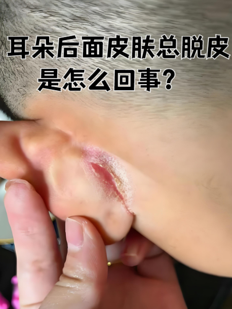 耳朵后面皮肤反复脱皮,可能是日常护理疏忽或潜在皮肤问题的信号