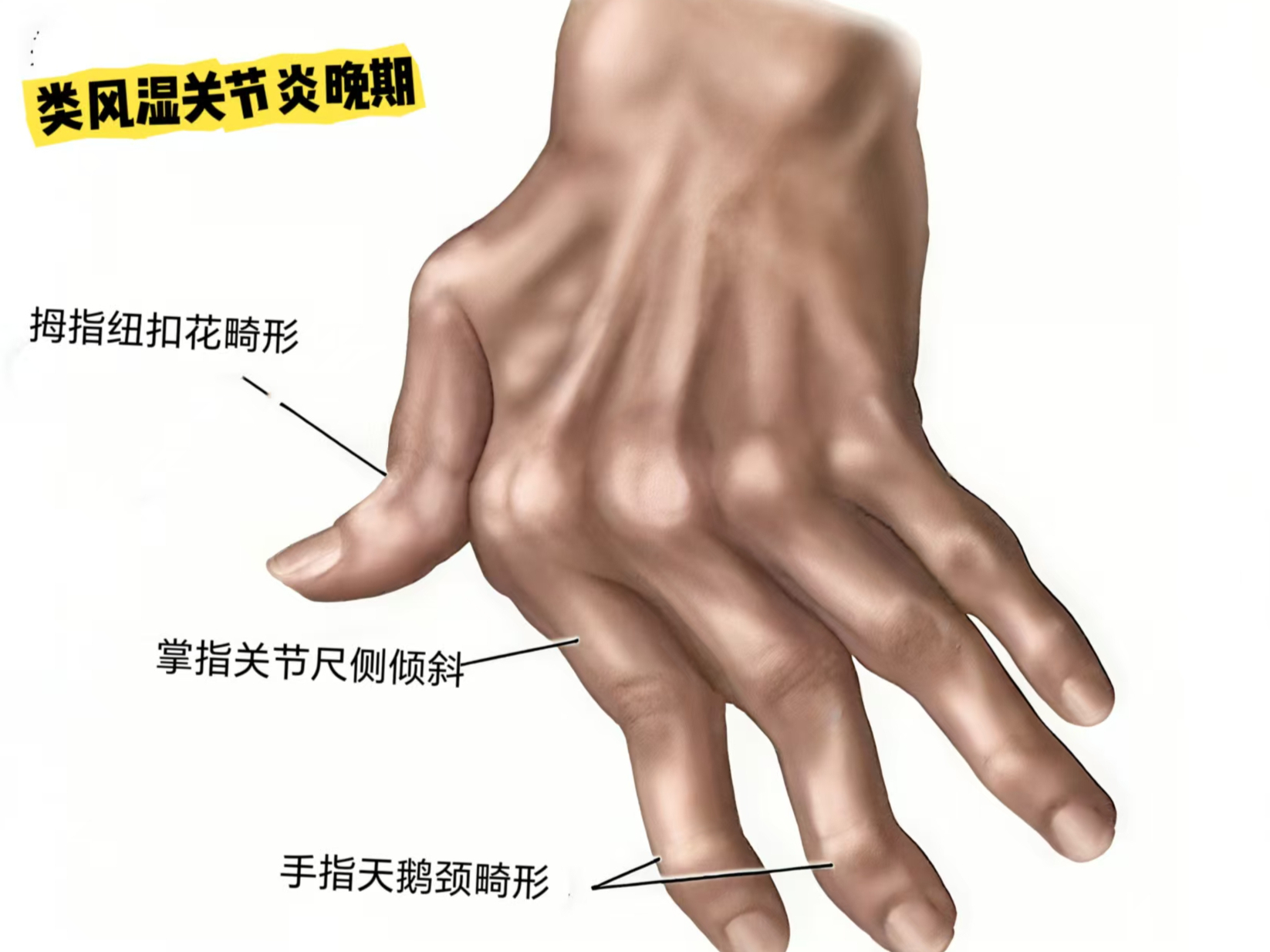 类风湿关节炎常导致手指出现三种典型畸形,分别是天鹅颈畸形,纽扣花