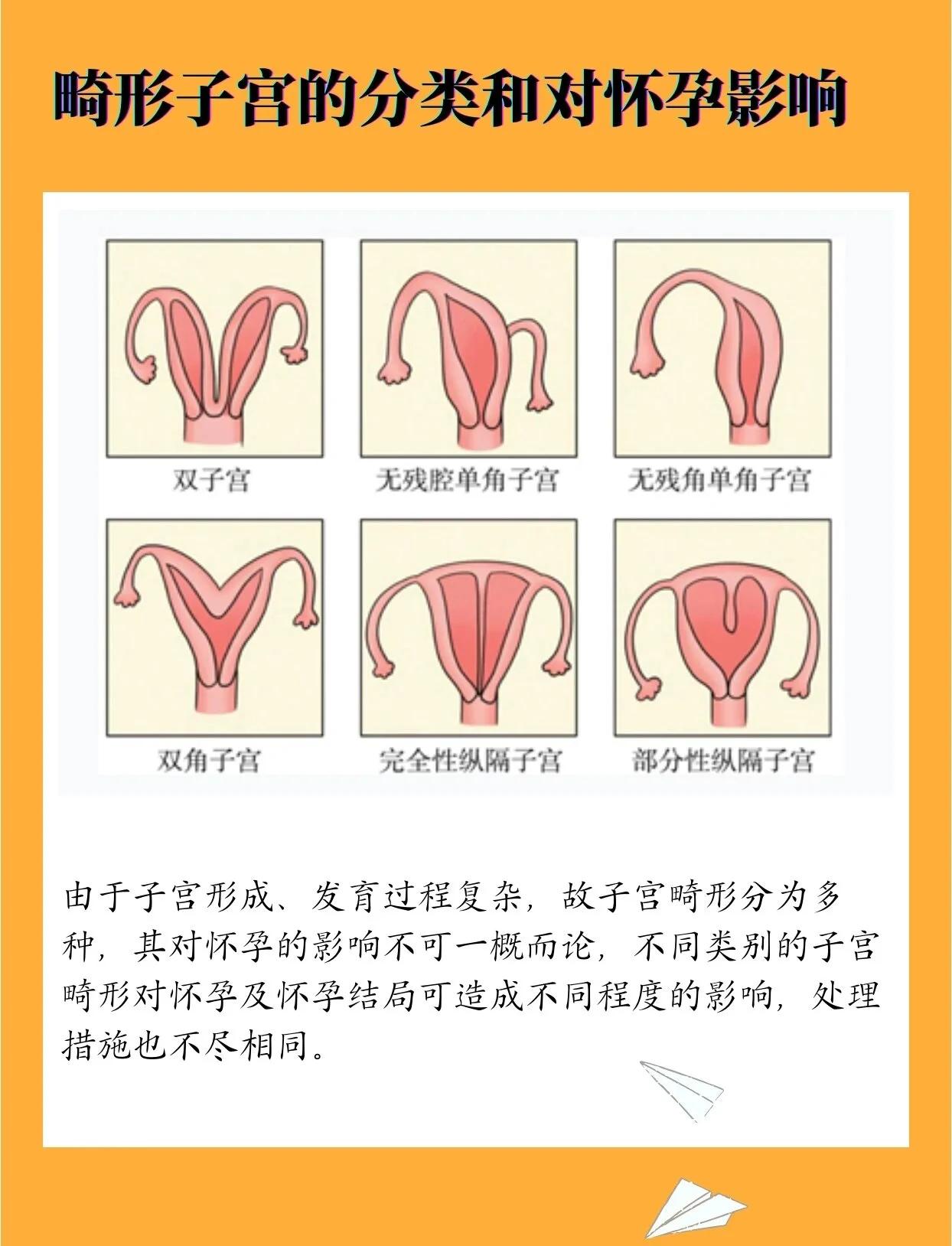 弓形子宫其实是子宫发育有点小问题