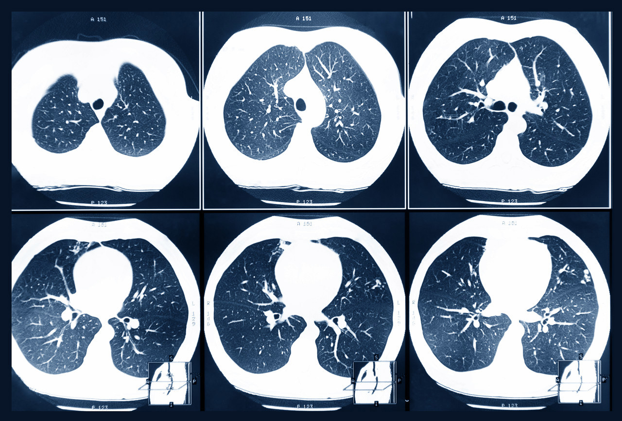 肺癌根本不用治?医生解答几个真相