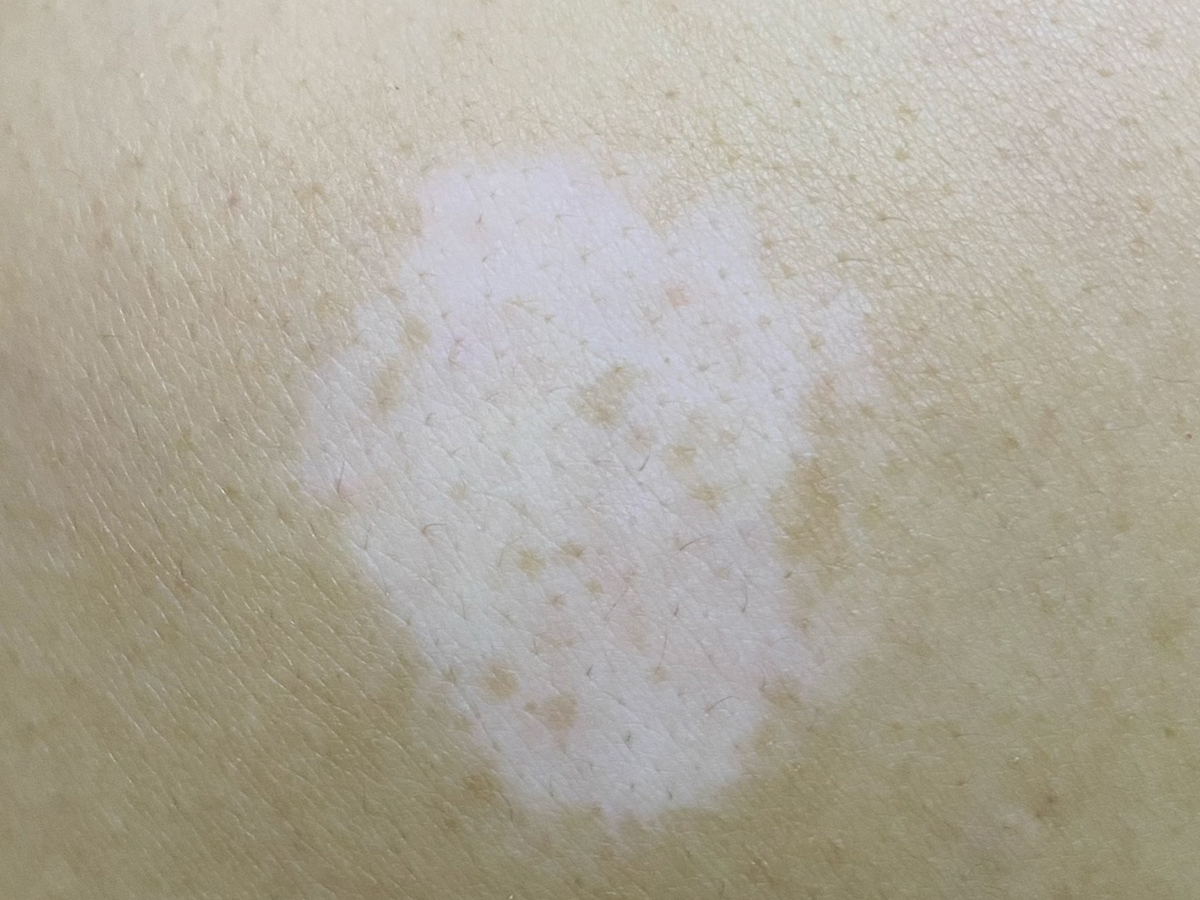 白斑会传染吗?常见的白斑以下几种谣言