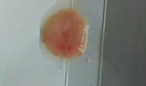 一起来看看:药流掉下来的孕囊图片