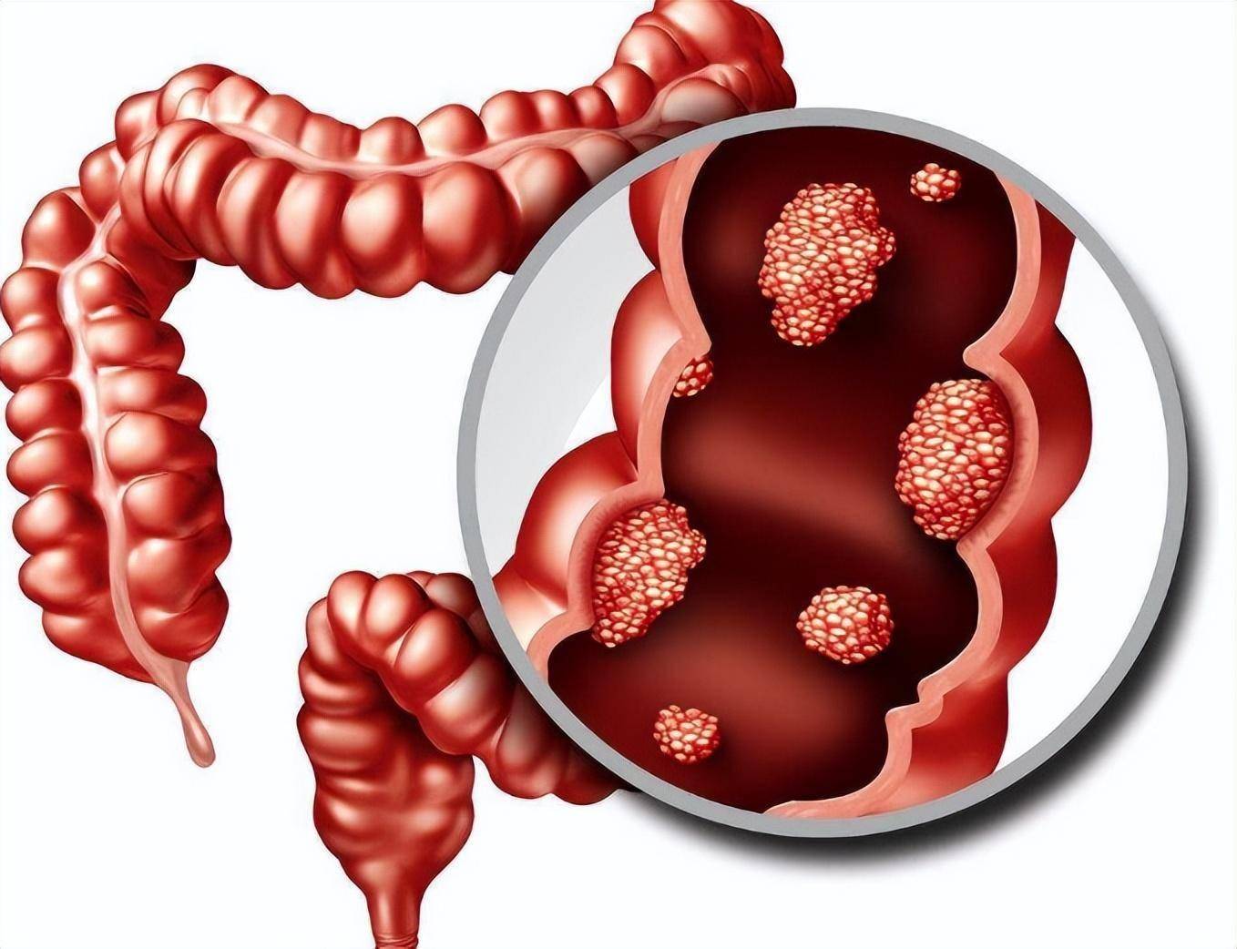 医生研究发现:肠癌患者不能做的事排名,你了解吗?