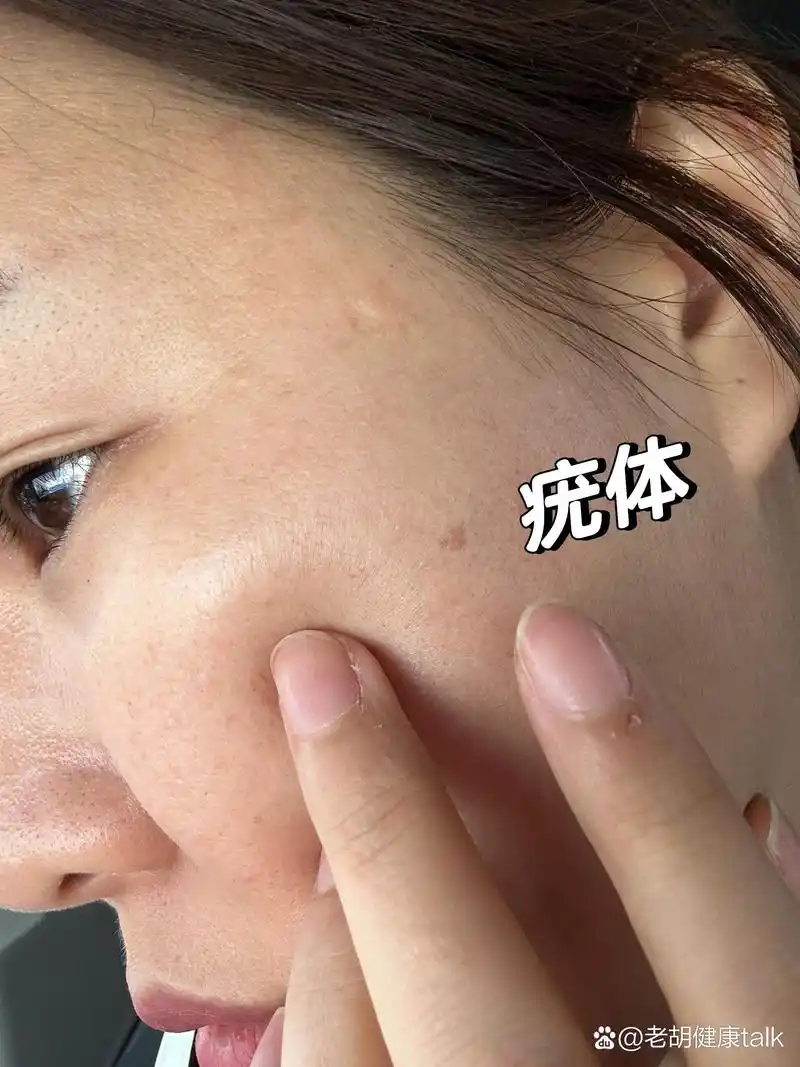 脸上长疣是传染的吗?