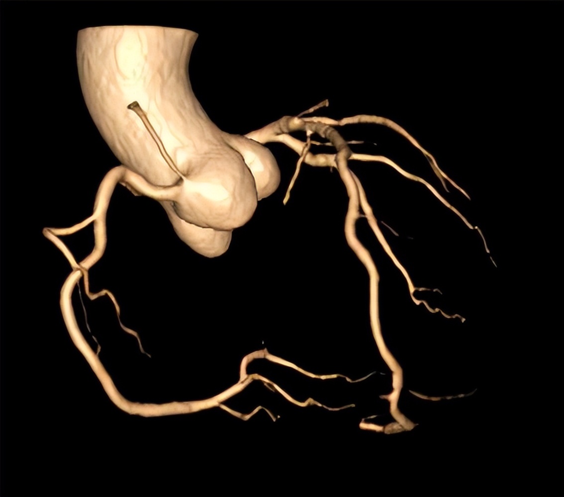 为什么不建议做冠脉cta检查
