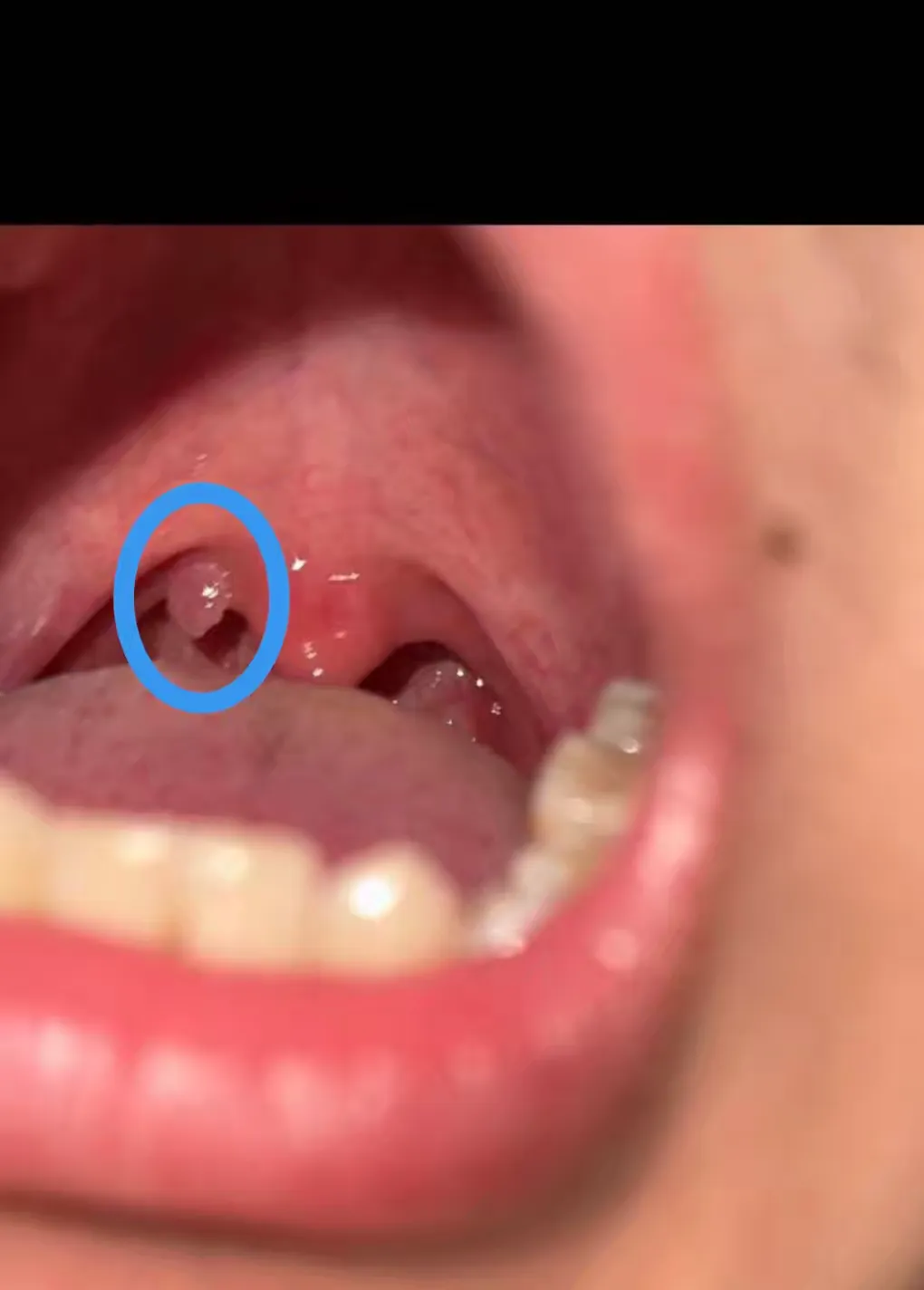 不痛不痒,喉咙里却长出"小黄豆":无症状咽部肿物确诊 hpv 乳头状瘤