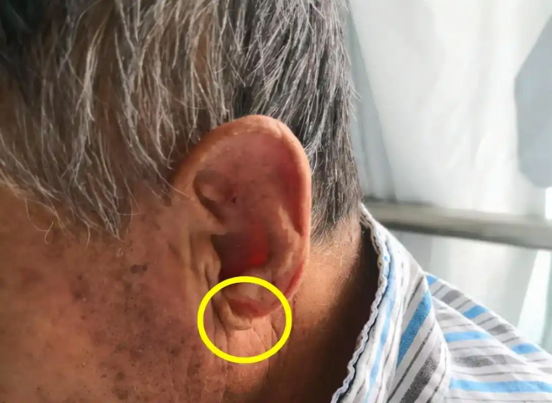 耳朵是心梗的"预警器"?医生:耳朵出现这4个症状,抓紧去医院