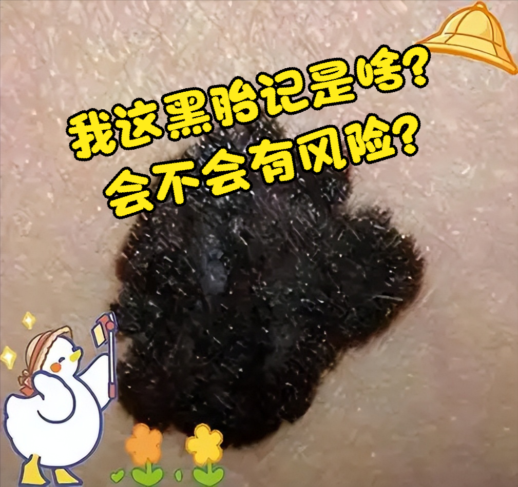 黑毛痣:常见在脸,额头,脖子,胸口这些显眼位置,摸起来可能鼓起来或