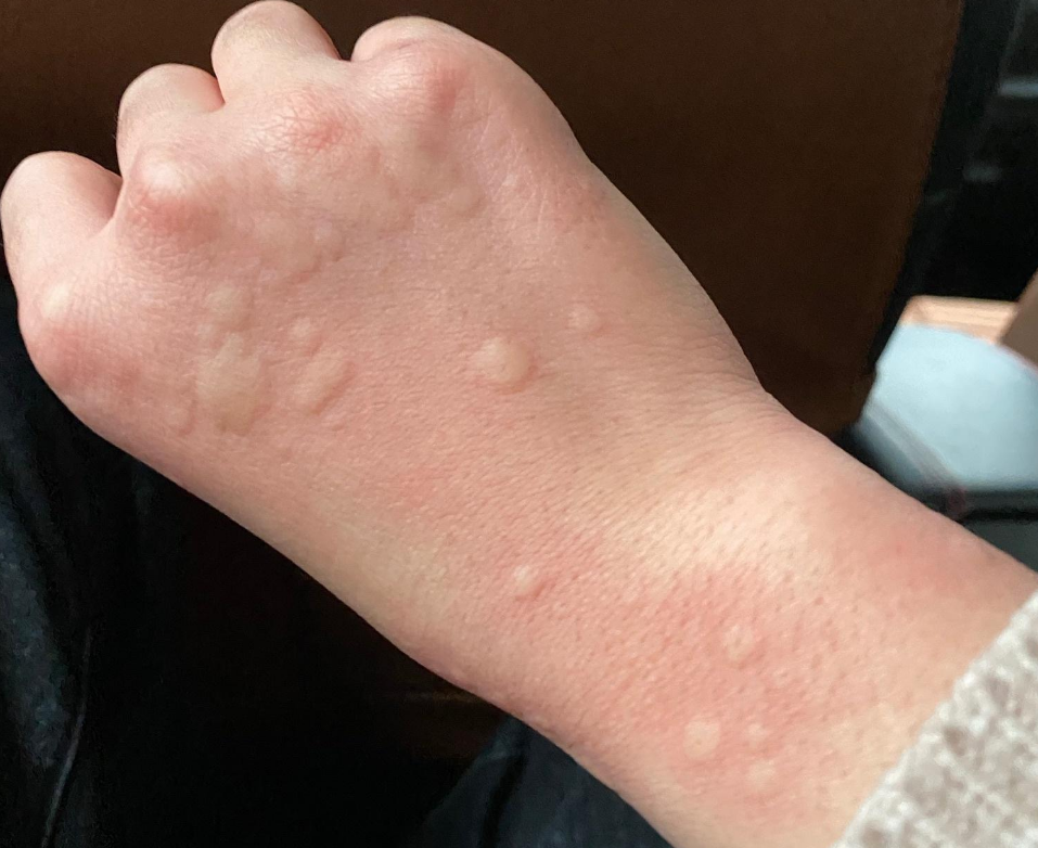 —荨麻疹风团瘙痒,内在病因各有不同,有人是血热生风,有