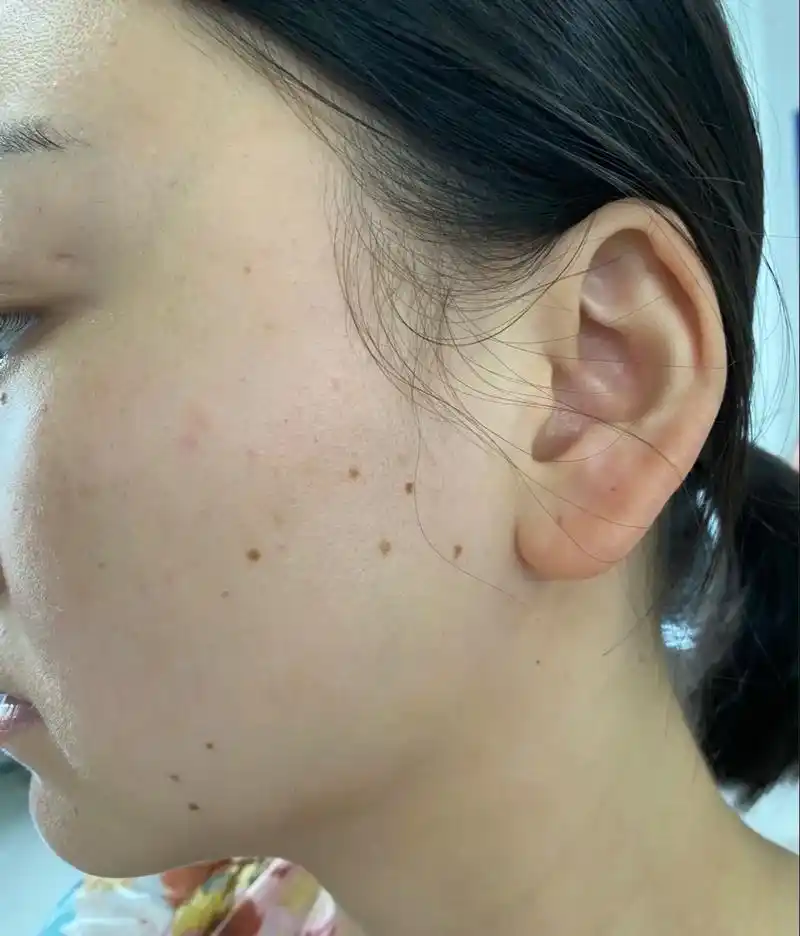 脸上长痣越来越多是身体出问题吗?