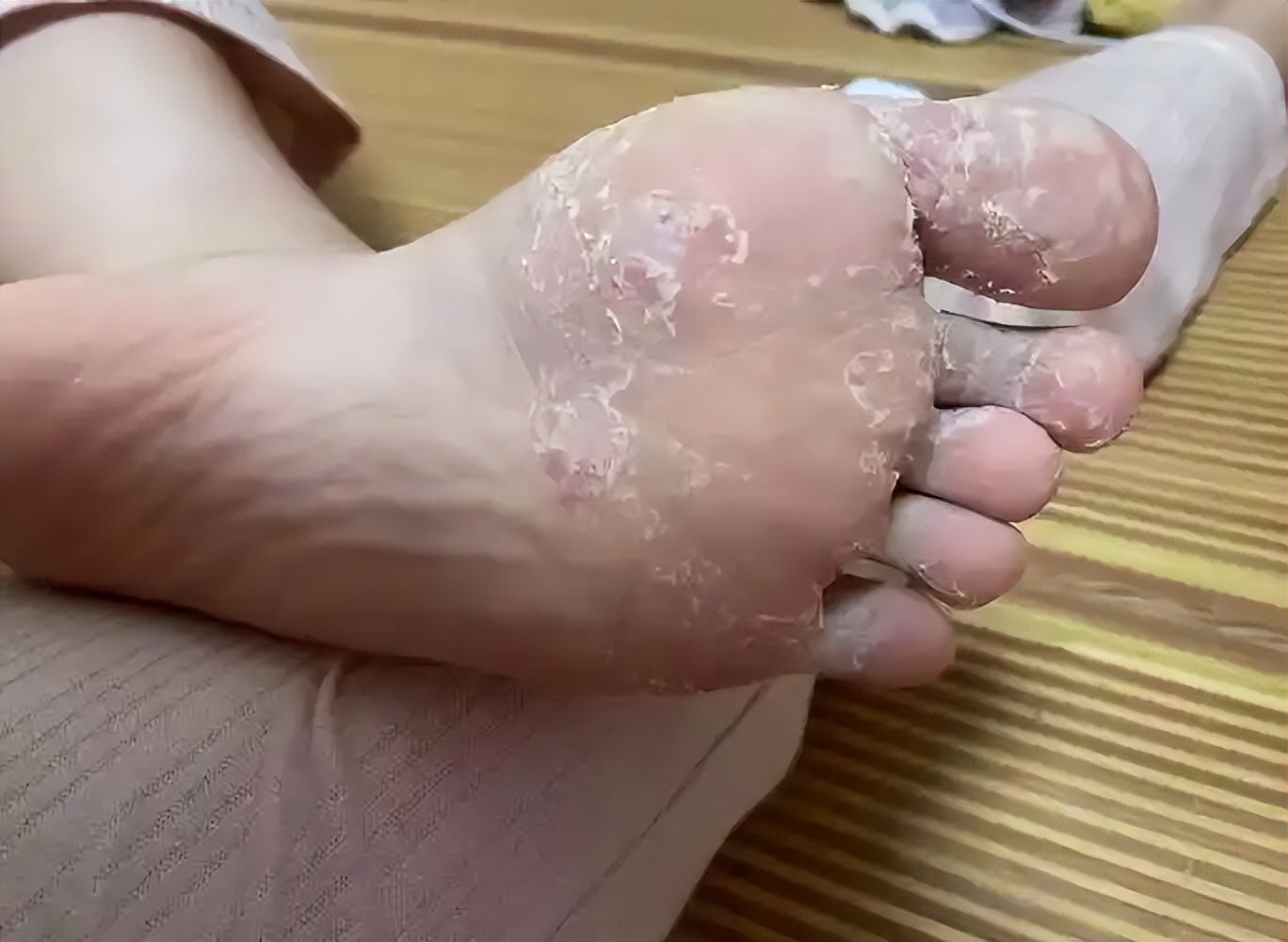 梅毒脚的典型表现!多数人却以为是得了脚气,白白耽误了病情