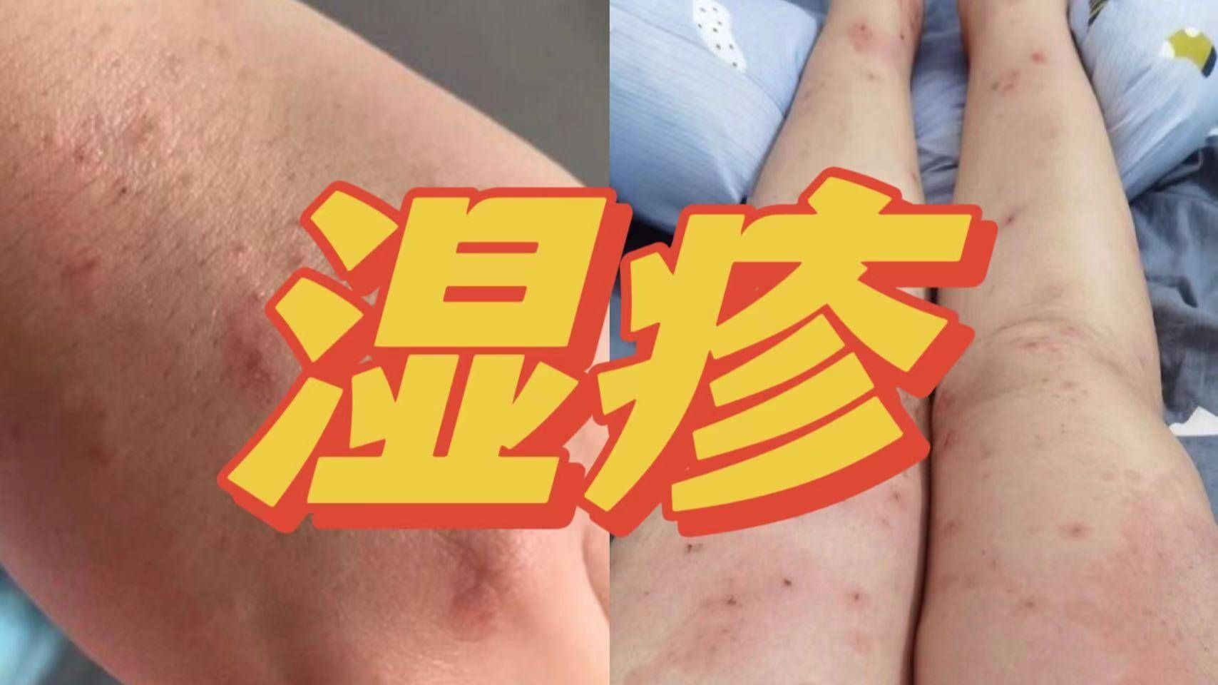 婴儿为什么有湿疹为什么在线 婴儿为什么有湿疹为什么在线