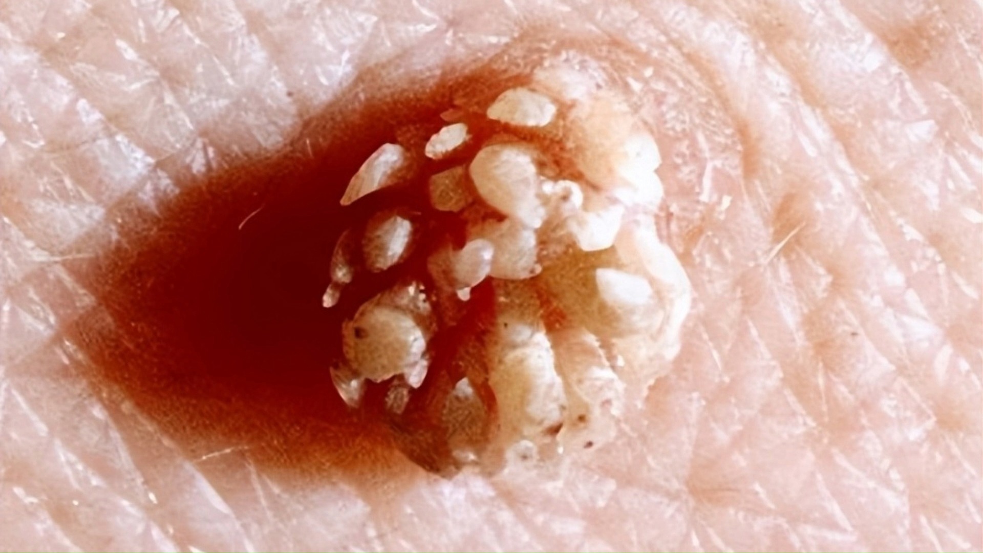 男性感染hpv以后,身体会陆续出现这些症状,医生:早期需警惕