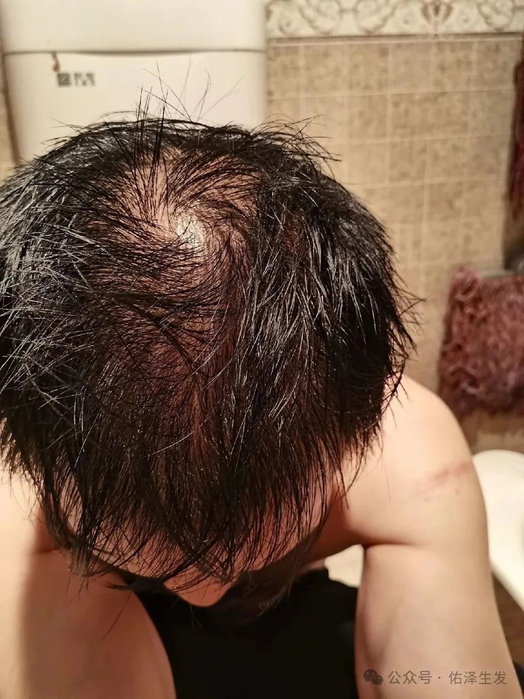 脱发秃顶还真的能治疗吗?来看下我亲身经历和生发记录过程吧