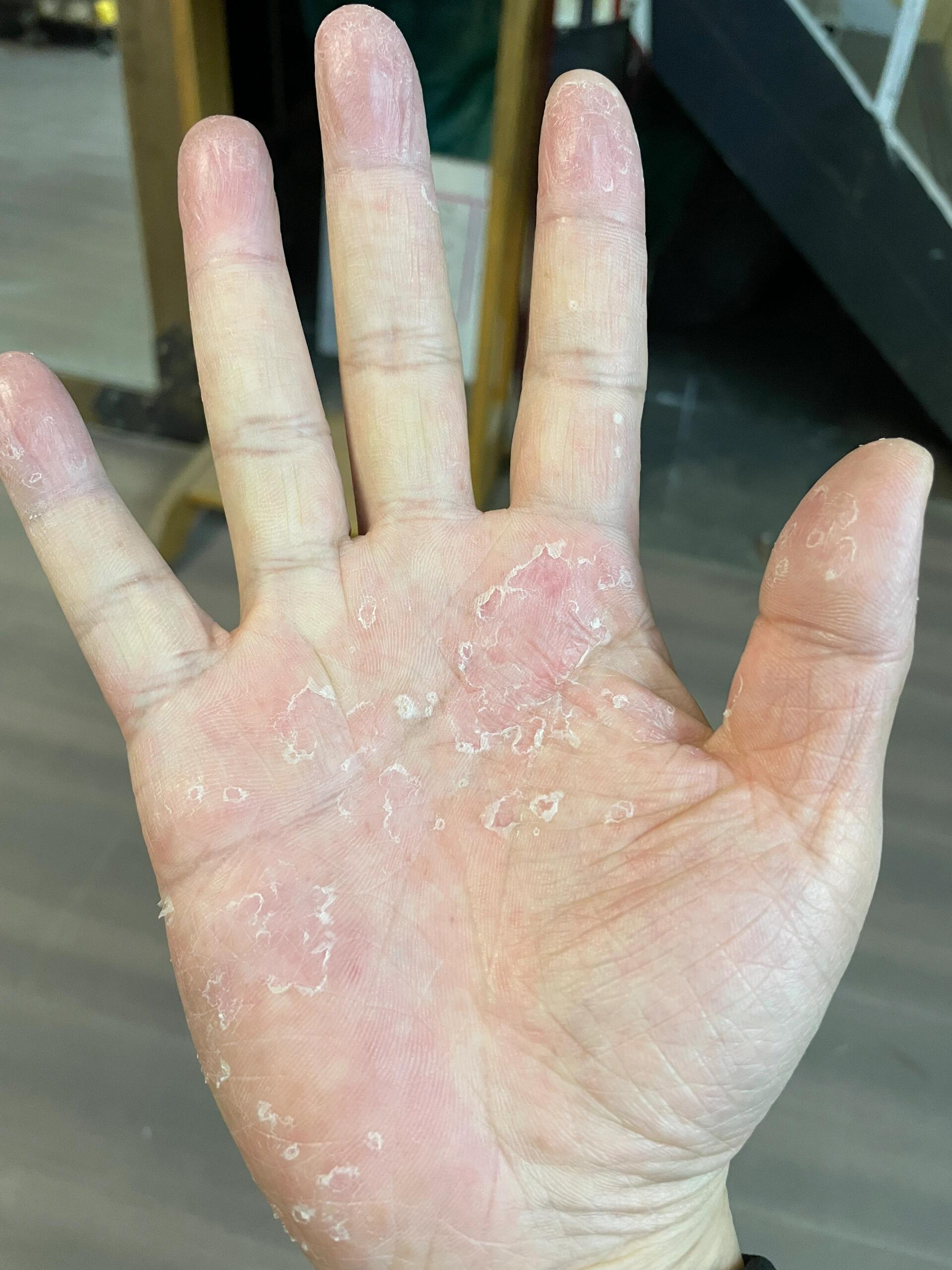 这3种皮肤病更常见 手掌脱皮不一定是缺维生素,很多时候与皮肤病有关