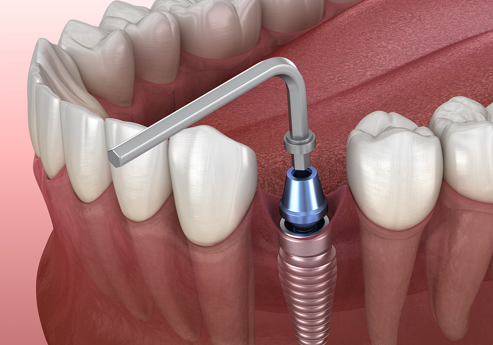 想做种植牙,能劝一个是一个!种牙前避开这三个坑,不要冲动去种牙!