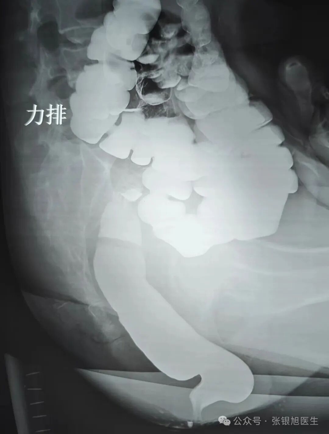 排粪造影"鹅颈征"背后的便秘真相:耻骨直肠肌肥厚 重度直肠前突