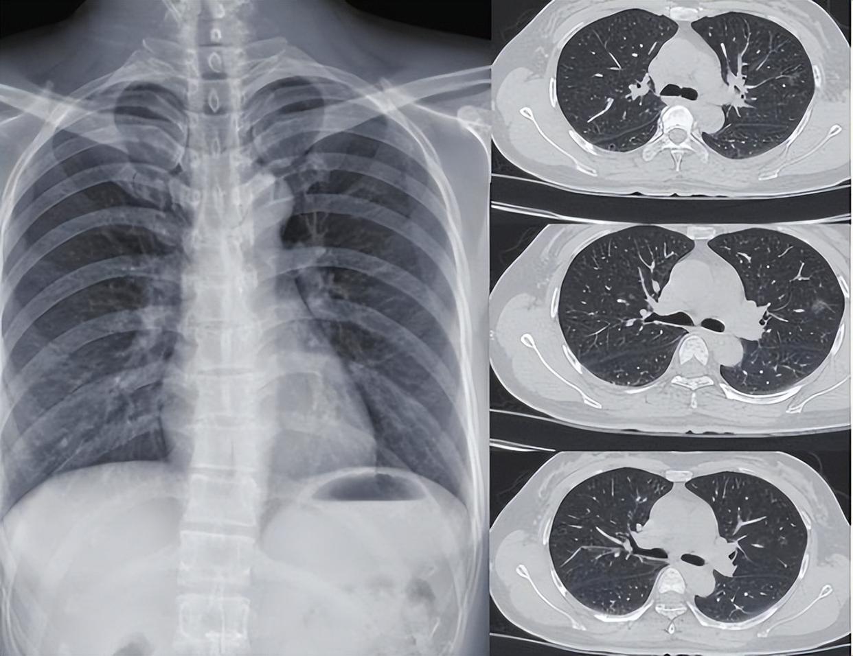 医生提醒:做过肺切除术,身体若出现这几种异常,要当心!