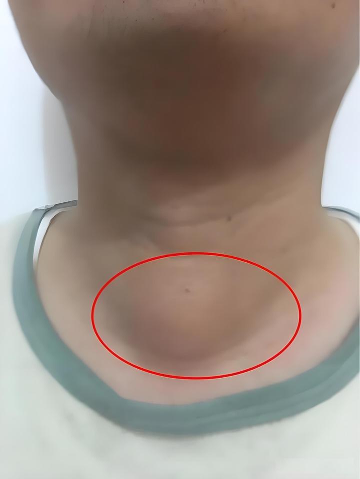 关于甲状腺结节,你需要了解的真相:不慌张,不忽视