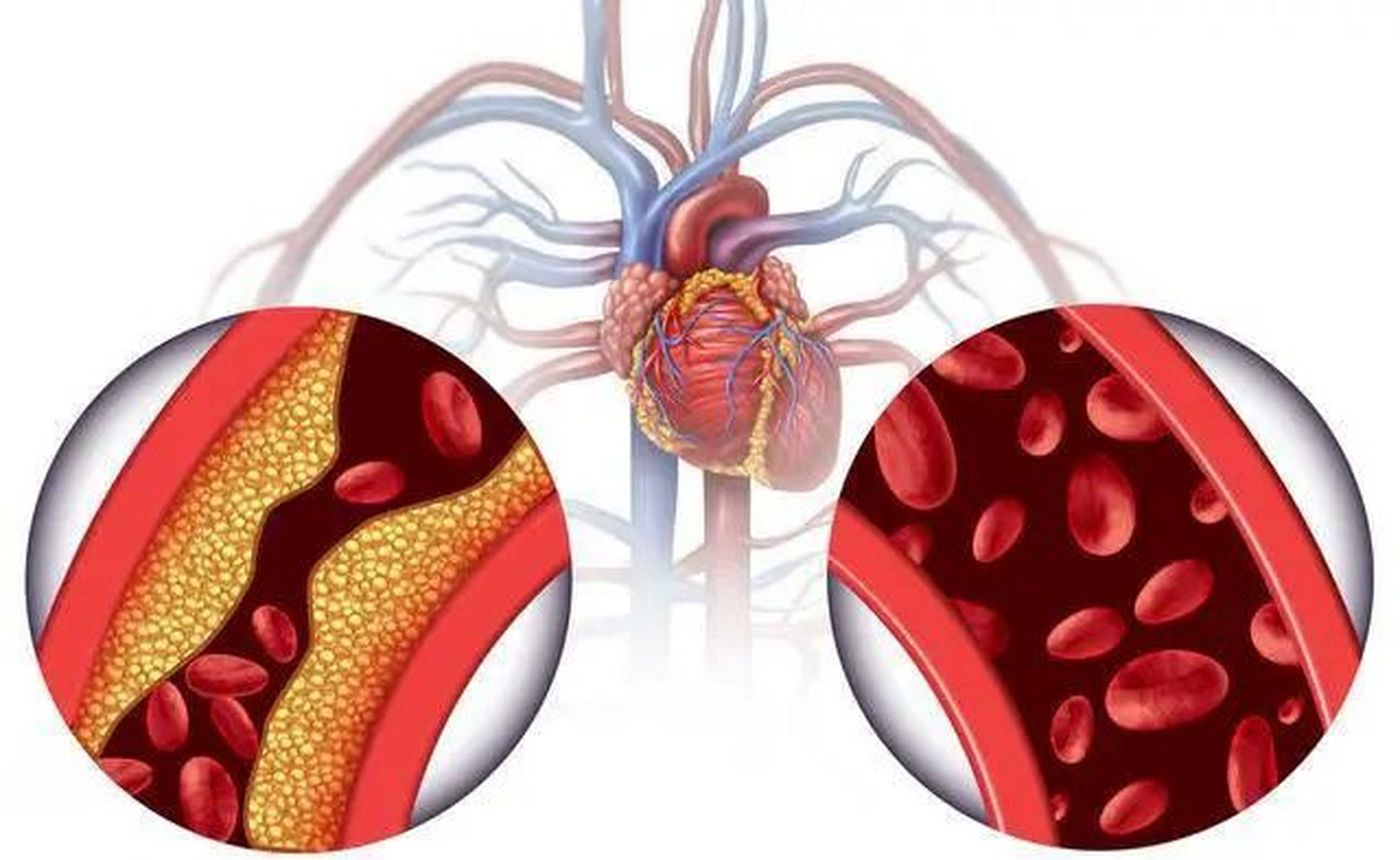 糖友们注意!近43万人研究发现:糖尿病患者补钙,死亡风险升高44%